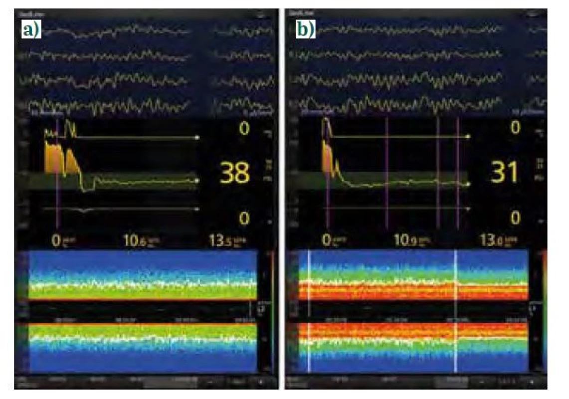 EEG křivky a spektrogramy anestezie sevofluranem (úvod propofolem,
sufentanil). a) muž, 72 let, plastika a. femoralis, mělčí doplňovaná
anestezie, PSI 38 (není na obrázku), MAC neuvedena, na spektrogramu jsou
patrné výrazné oscilace v pásmech SW-δ (< 4 Hz) a α (8-12 Hz), hodnoty
SEF95 do 15 Hz svědčí o dostatečné antinocicepci, b) žena, 69 let, aorto-ilický
bypass, doplňovaná anestezie, PSI 31, MAC korigovaná k věku 0,9 (není na
obrázku), na spektrogramu jsou patrné výrazné oscilace v pásmech SW-δ
(< 4 Hz), θ (4-7 Hz) i α (8-12 Hz), tj. fenomén fill-in, SEF95 poněkud kolísá,
proto ještě přidán sufentanil 25 μg i. v. (označeno druhou svislou bílou linií),
antinocicepce posílena