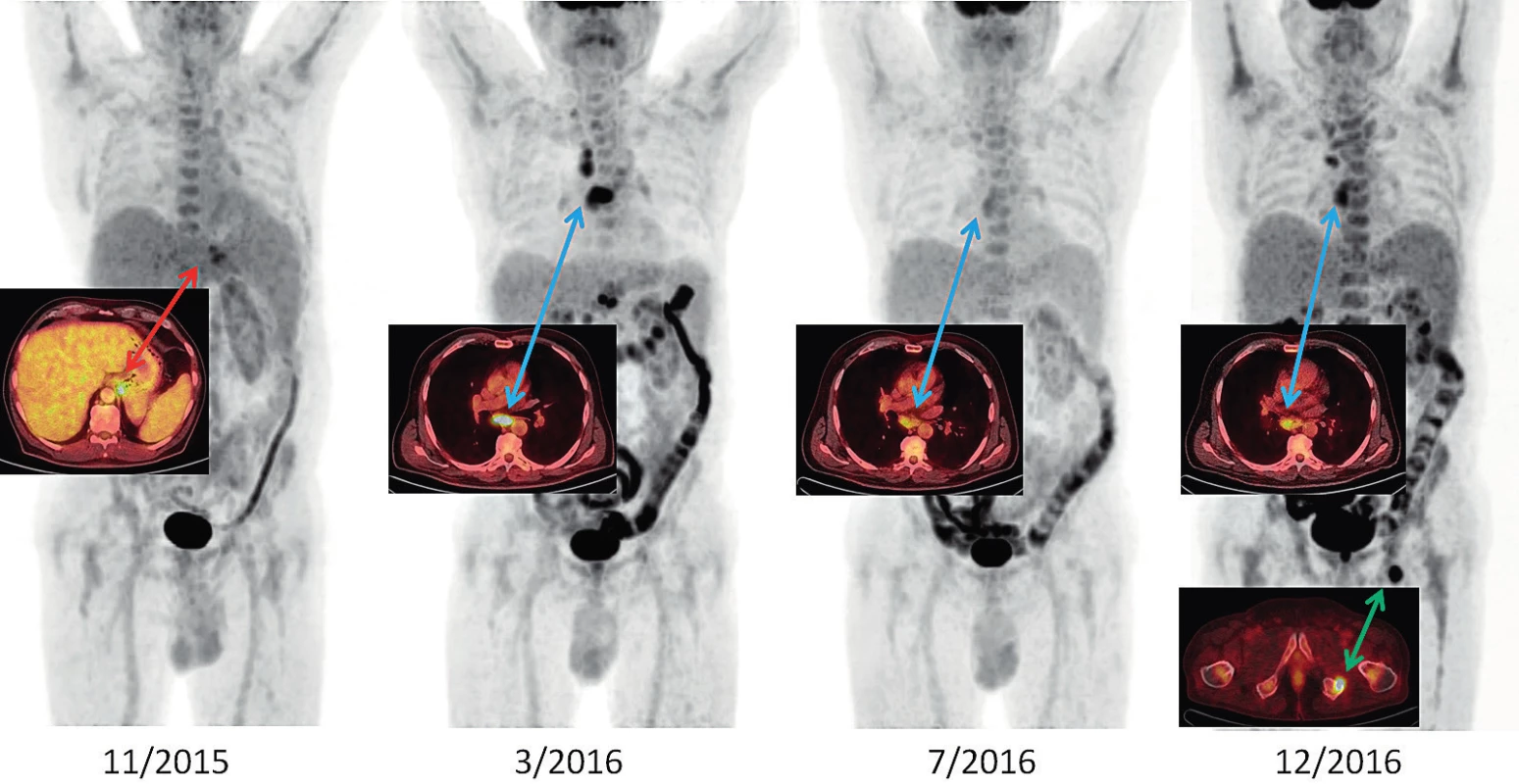 Vývoj Stillovy nemoci v období 11/2015–12/2016 v PET/CT zobrazení u našeho pacienta<br>
11/2015: metabolicky aktivní lymfadenopatie při kardii a u levého bráničního crus (SUVmax 6,1), lehce pozitivní nález v retroperitoneu a v kostní dřeni<br>
3/2016: rozvinutý nález, lymfadenopatie za pravou klíční kostí, v mediastinu SUVmax 10,1; v retroperitoneu SUVmax 10,1; kostní dřeň lehce pozitivní<br>
7/2016: negativní PET/CT obraz, velikostně regrese uzlin, akumulace jen hraniční, remise nemoci<br>
12/2016: progrese nemoci hlavně v mediastinu a nově ložisko v sedací kosti vlevo (před léčbou anakinrou)