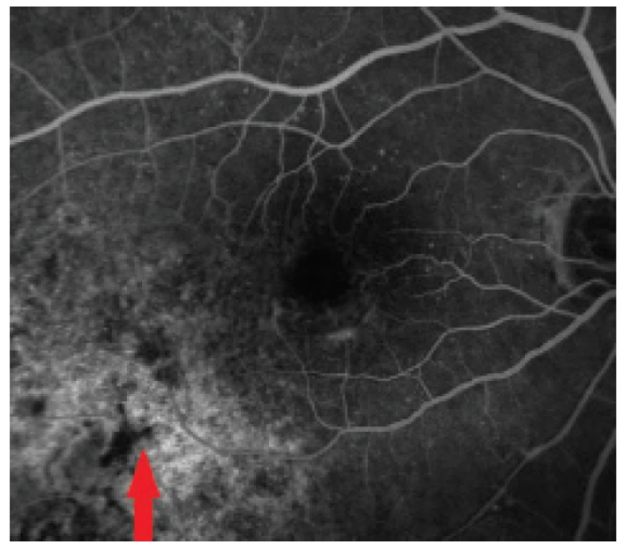 Fluorescein angiography of tumour deposit 4 years
later in 2017