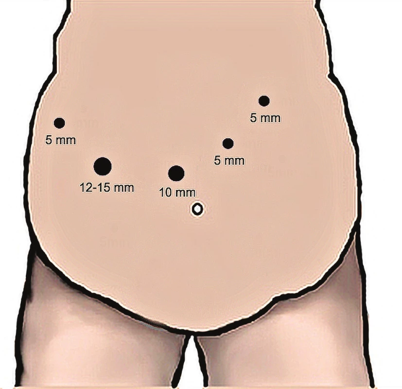 Pozice trokarů při SADIS
10mm − port pro video, 12–15mm − port pro stapler<br>
Fig. 3: SADIS – position of the trocars
10mm − port for video, 12−15mm − port for the stapler