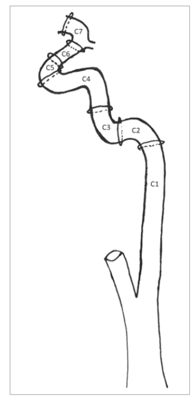 Segmenty a. carotis interna
(podle Bouthillier et al., 1996 [1]).<br>
Fig. 1. Segments of the internal carotid
artery (according to Bouthillier et al.,
1996 [1]).