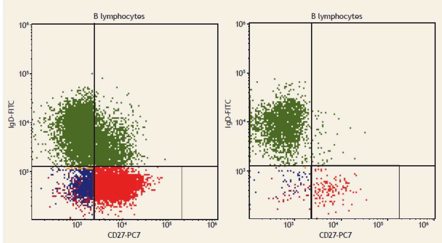 Flow cytometry. Switched memory B lymphocytes (CD19+CD27+IgD-), displayed as red dots. On the left:
a healthy blood donor; Switched memory B lymphocytes (CD19+CD27+IgD-) comprise 3% of all B lymphocytes.
On the right: a patient with coeliac disease; Switched memory B lymphocytes (CD19+CD27+IgD-) comprise 1.5%
of all B lymphocytes.<br>
Obr. 2. Průtoková cytometrie. Paměťové B lymfocyty (CD19+CD27+IgD-), zobrazeny jako červené tečky. Vlevo: zdravý dárce
krve; paměťové B lymfocyty (CD19+CD27+IgD-) tvoří 3 % všech B lymfocytů. Vpravo: pacient s celiakií;paměťové B lymfocyty
(CD19+CD27+IgD-) tvoří 1,5 % všech B lymfocytů.