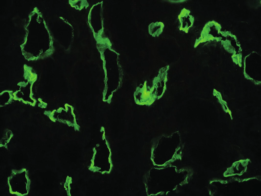 Pozitivita peritubulárních kapilár v imunofluorescenčním průkazu C4d složky
komplementu (400x), z archivu MUDr. J. Háčka.<br>
Fig. 1. Immunoflourescence detection of the complement split product C4d deposition
in peritubular capillaries (magnification x 400), J. Háček archive.