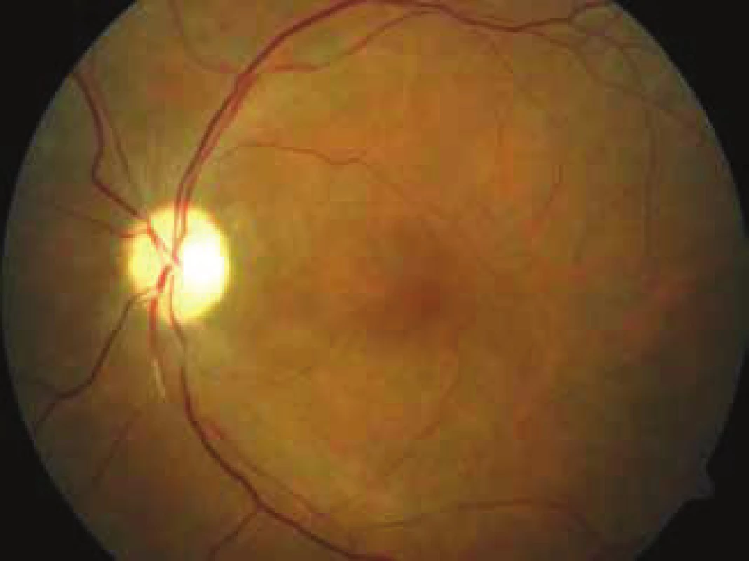 Photograph of ocular fundus of left eye 4 weeks after
procedure