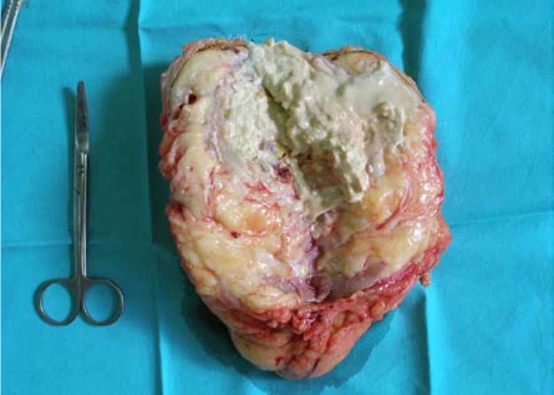 Preparát levé ledviny: TB ledviny – kaverna
vyplněna kaseózními hmotami<br>
Fig. 6. Left kidney TB: a cavern is filled with caseous
substance