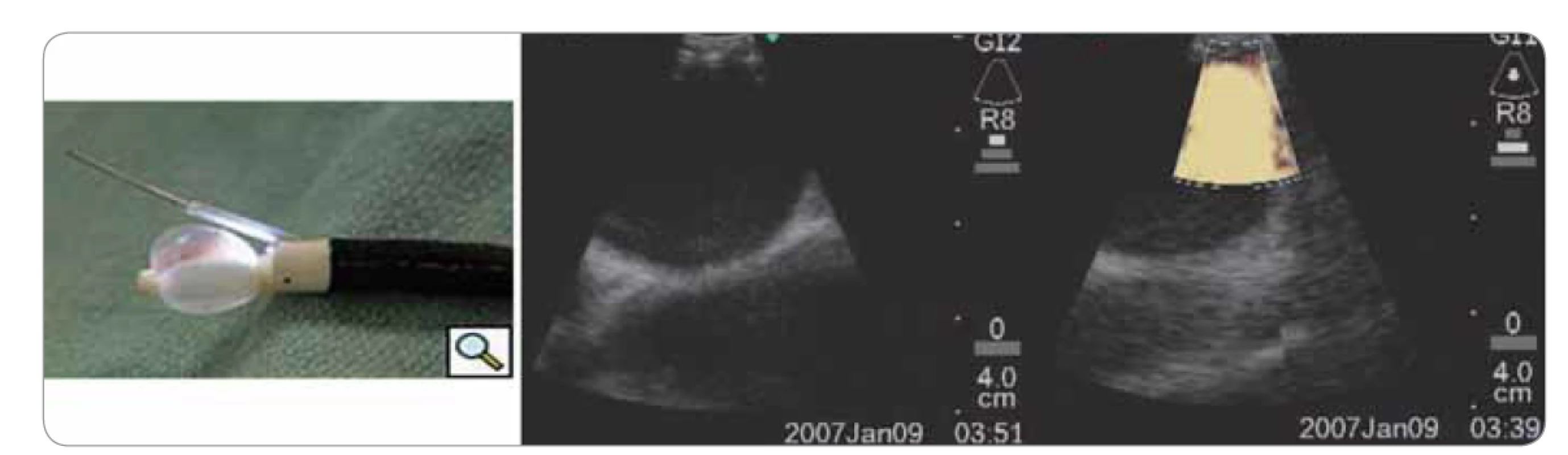 Endobronchiální ultrazvuk.