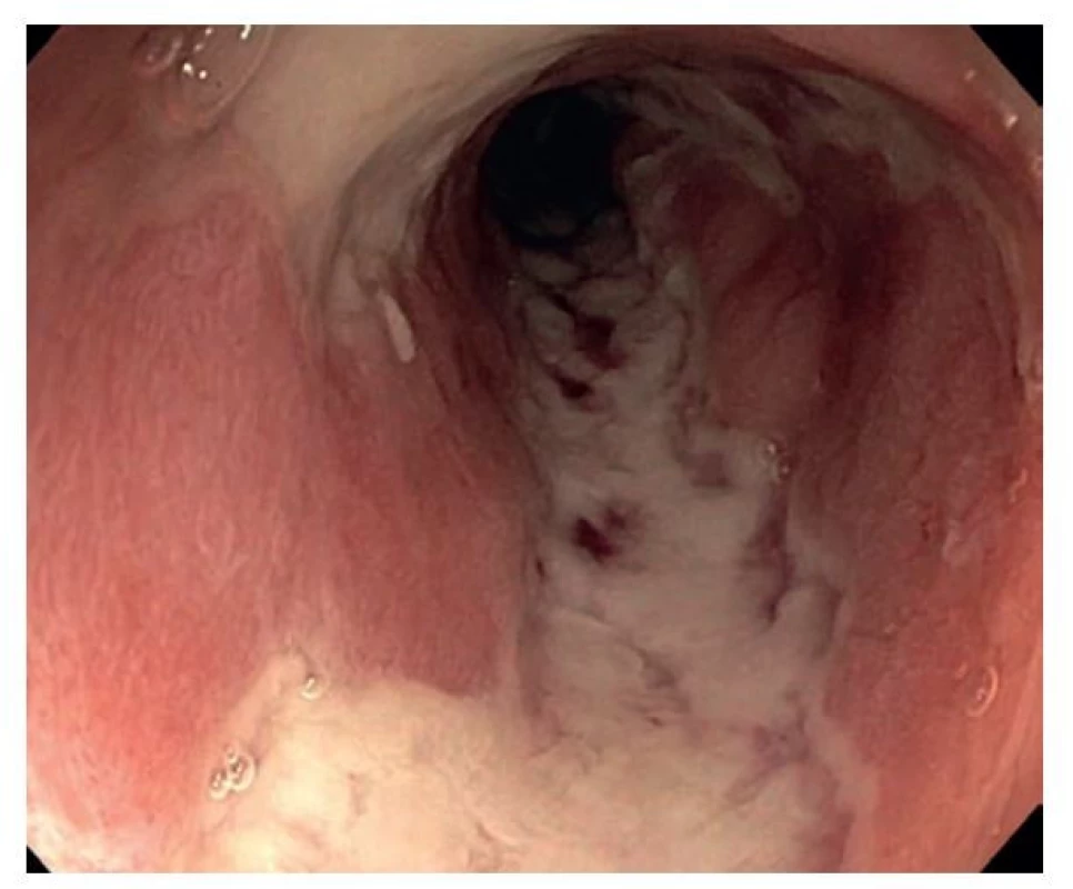 Endoskopický snímek terminálního ilea s plazivými ulceracemi
u pacienta s aktivní Crohnovou chorobou (publikováno se souhlasem Kliniky
hepatogastroenterologie, Institut Klinické a Experimentální Medicíny,
Praha).
