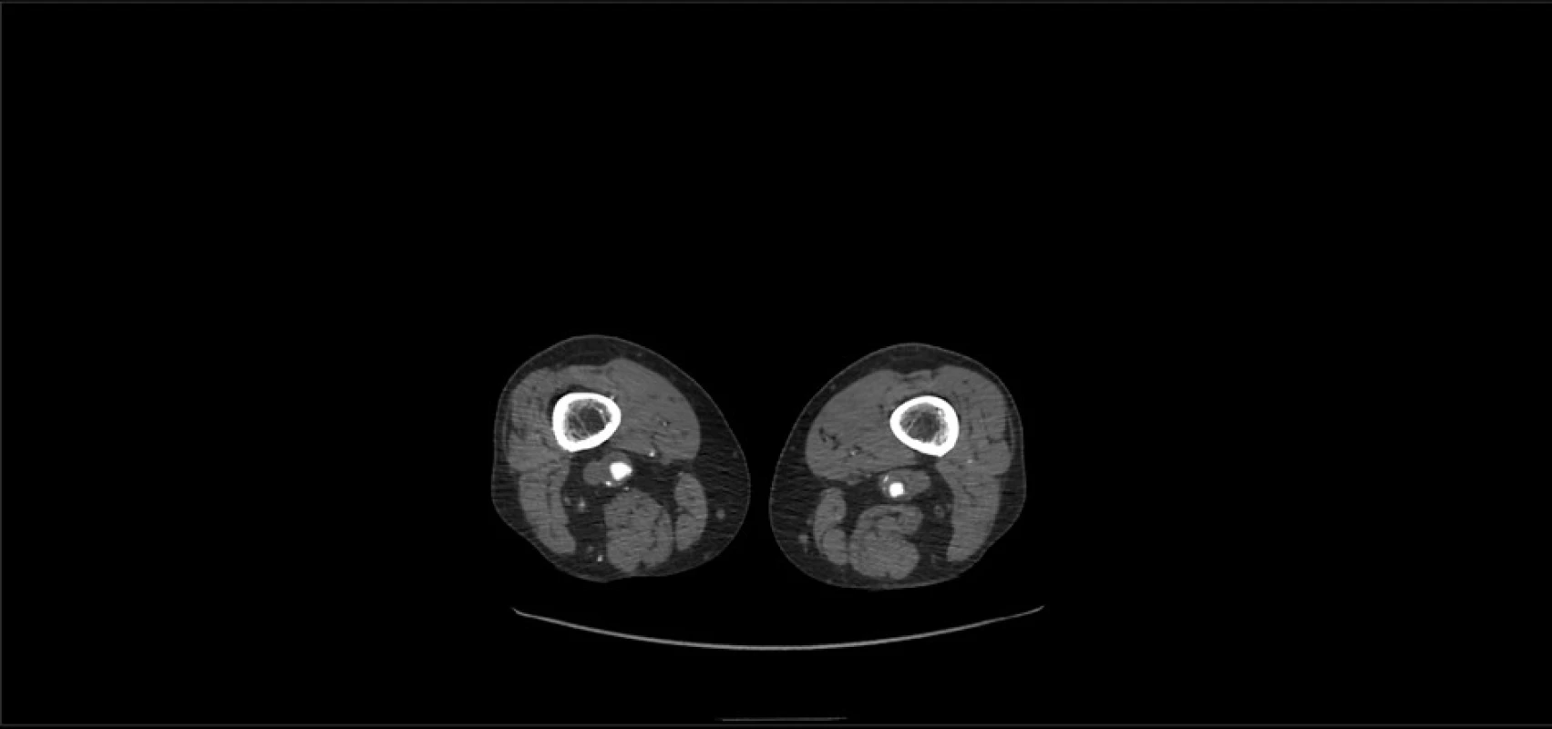 CT angiografie – výdutě podkolenních tepen –
příčný řez<br>
Fig. 2: CT angiography – popliteal artery aneurysms –
cross-section