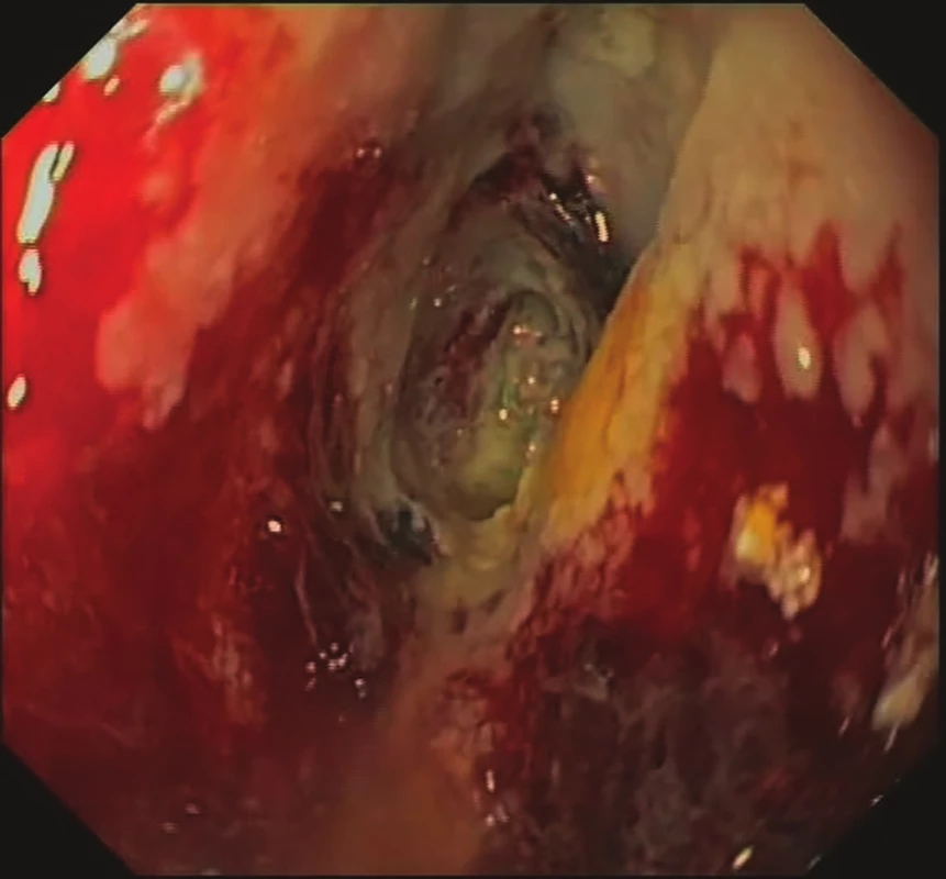 7. den EVAC – odlučující se nekrózy, formující se
granulační tkáň<br>
Fig. 3: EVAC, day 7 – necrosis, granulation tissue formation