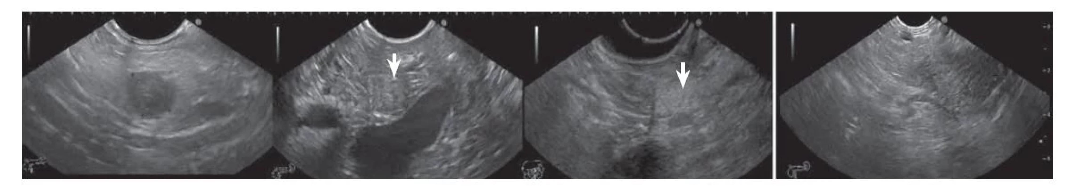 PNET v B-móde hypoechogénny (obrázok prvý zľava, tumor označený krížikmi), izoechogénny (obrázok druhý
zľava, tumor označený šípkou), hyperechogénny (obrázok tretí zľava, tumor označený šípkou), zmiešanej echogenity
(obrázok prvý zprava, tumor označený krížikmi).<br>
PNET – pankreatický neuroendokrinný tumor. Zdroj: archív autora.<br>
Fig. 3. PNET in B-mode hypoechoic (first image from left, tumor marked with crosses), isoechoic (second image from left, tumor
marked with arrow), hyperechoic (third image from left, tumor marked with arrow), mixed echogenicity (first image from
right, tumor marked with crosses).<br>
PNET – pancreatic neuroendocrine tumor. Source: author‘s archive.