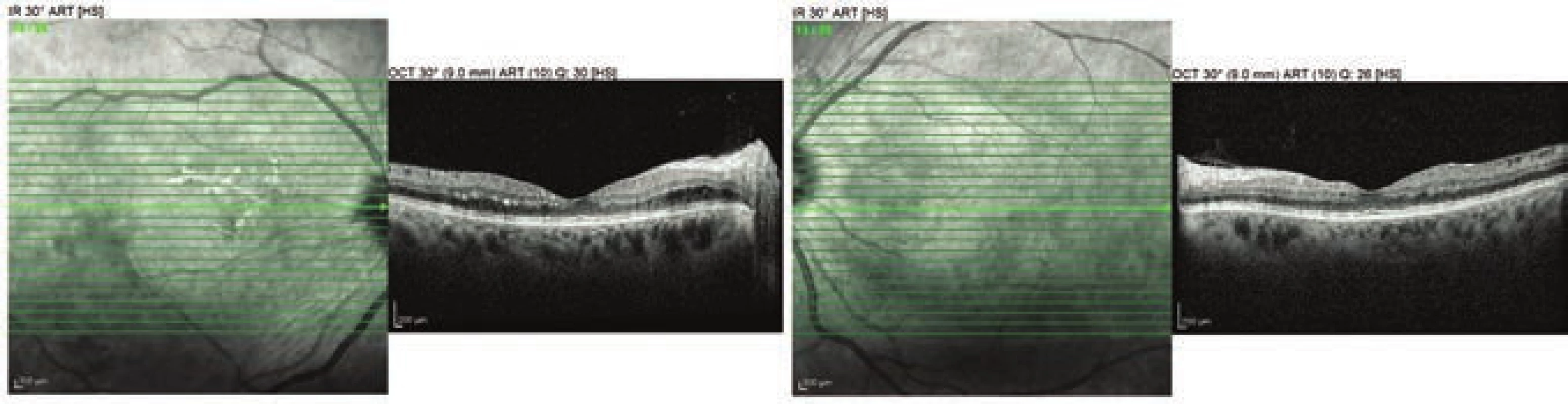 OCT examination of both eyes in 6th week of first pregnancy
