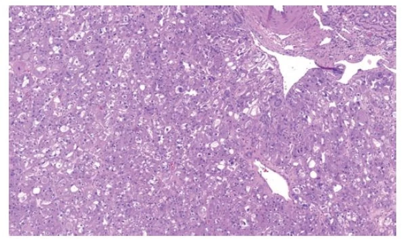 EVT je solidní tumor tvořený objemnými onkocytickými buňkami
s velkými vakuolami a „high-grade“ jádry.