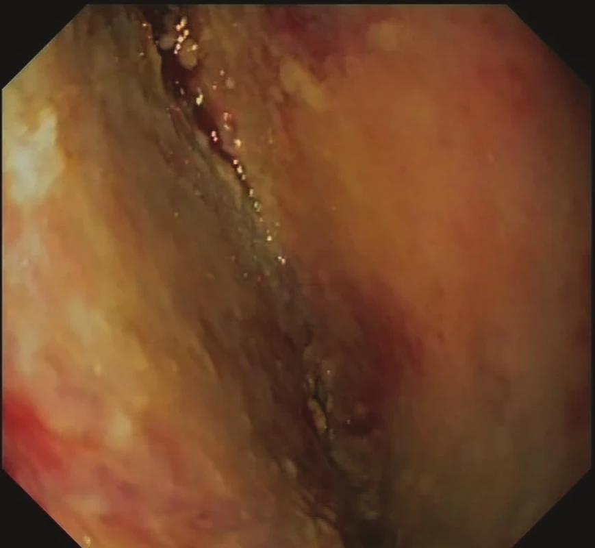 12. den EVAC − granulující tkáň mediastina<br>
Fig. 4: EVAC, day 12 − mediastinal granulation tissue