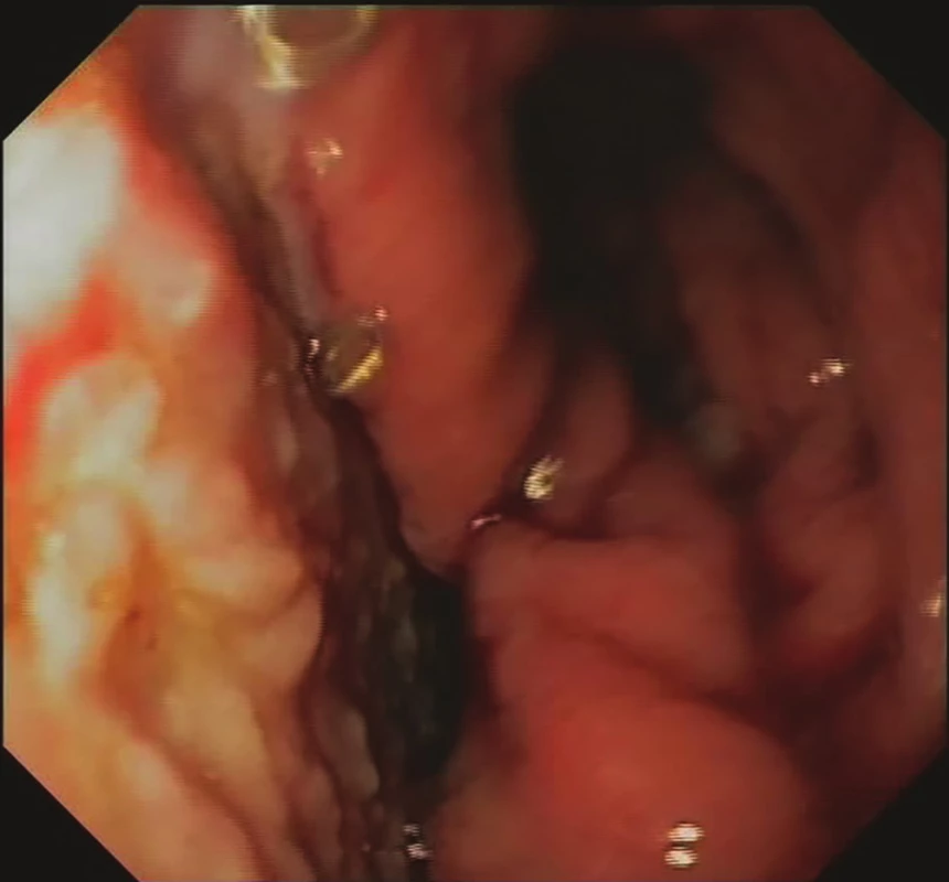21. den EVAC− mediastinální granulace, regrese
velikosti leaku, konverze k intraluminální EVAC
Fig. 5: EVAC, day 21 – mediastinal granulation, regression<br>
of the leak size, conversion to intraluminal EVAC