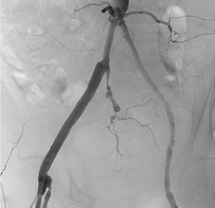 Stentgraft a. iliaca interna dextra<br>
Fig. 5. Right internal iliac artery stent graft