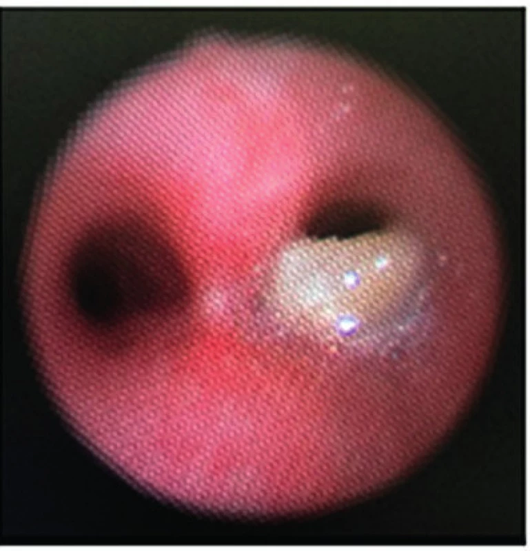 Organické cudzie teleso (orech) čiastočne obturujúce pravý hlavný bronchus v endoskopickom obraze. <br> Fig. 5.  An organic foreign body (a walnut) partially enclosing the right main bronchus in an endoscopic image.
