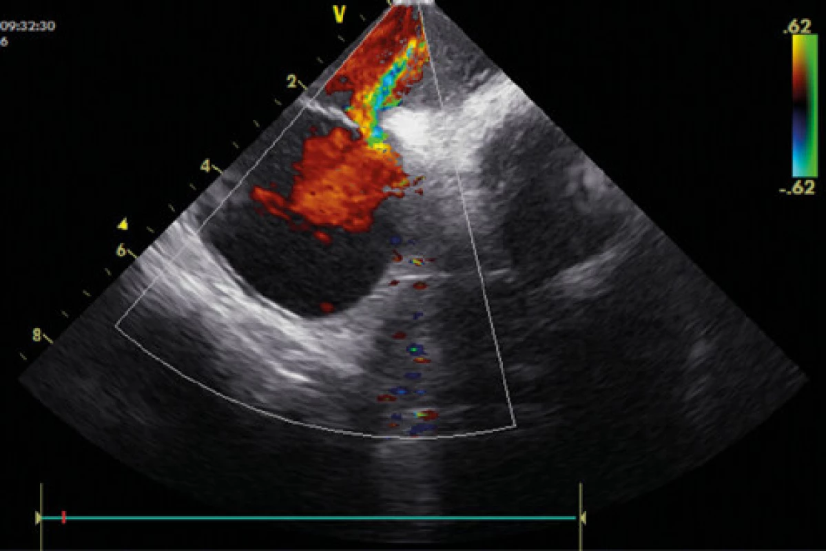 Patentní foramen ovale – zkrat dle barevného dopplerovského 
echo vyšetření (ICE – intrakardiální echokardiografie)