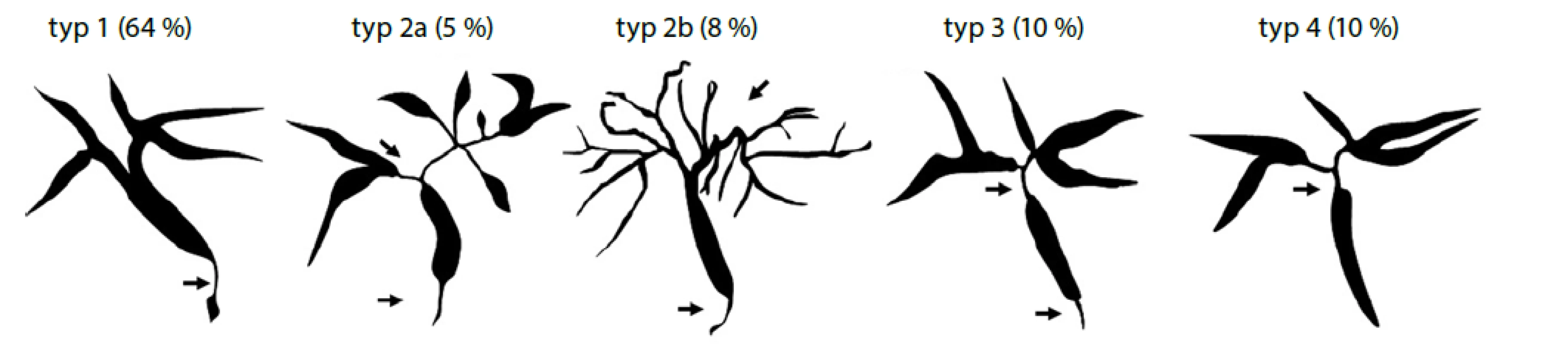 Klasifikace IgG4 asociované cholangitidy na základě cholangiogramu (převzato z Nakazawa et al. 2006)(66)