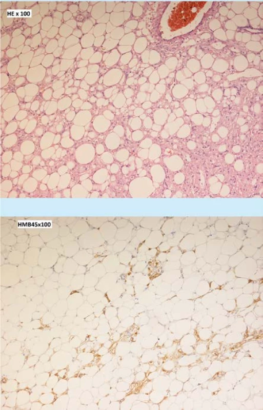 Histologický nález angiomyolipom v barvení
hematoxylin-eosin (a) a pozitivita HMB45 v perivaskulárních epiteloidních buňkách (b).<br>
Fig. 3. Histological finding of angiomyolipoma in
hematoxylin-eosin staining (a) and HMB45 positivity
in perivascular epithelioid cells (b).