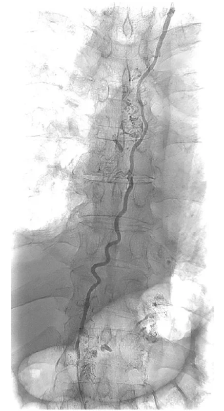 Skiaskopické zobrazení ductus thoracicus podáním
jodové kontrastní látky do mikrokatétru <br> 
Fig. 5. Fluoroscopy of thoracic duct during administration
of iodine contrast medium into microcatheter
