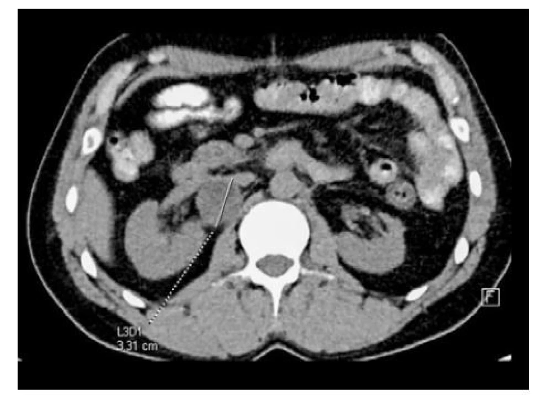 Recidiva tumoru parakaválně vpravo<br>
Fig. 3. Right paracaval tumor recurrence