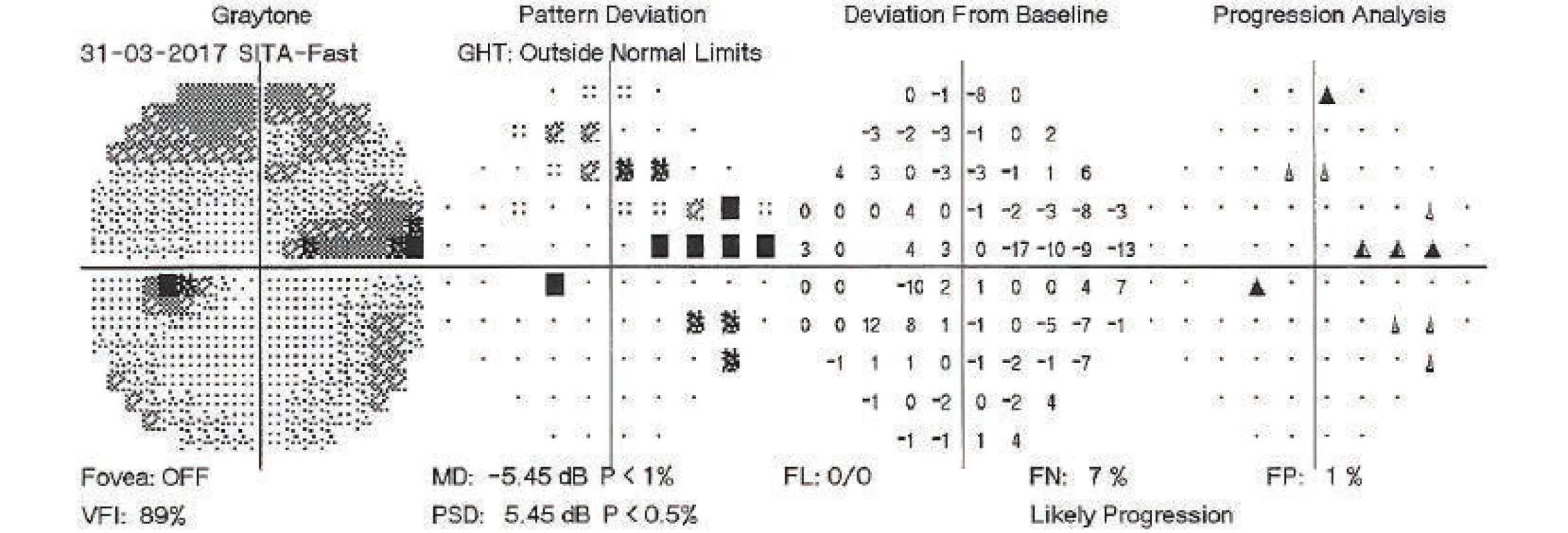 Perimetric examination of left eye, 31 March 2017