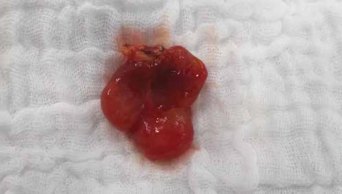 Stopkatý útvar vyrůstající z gingivy horní čelisti.<br>
Fig. 3. A formation growing out of the gingiva of the upper jaw.
