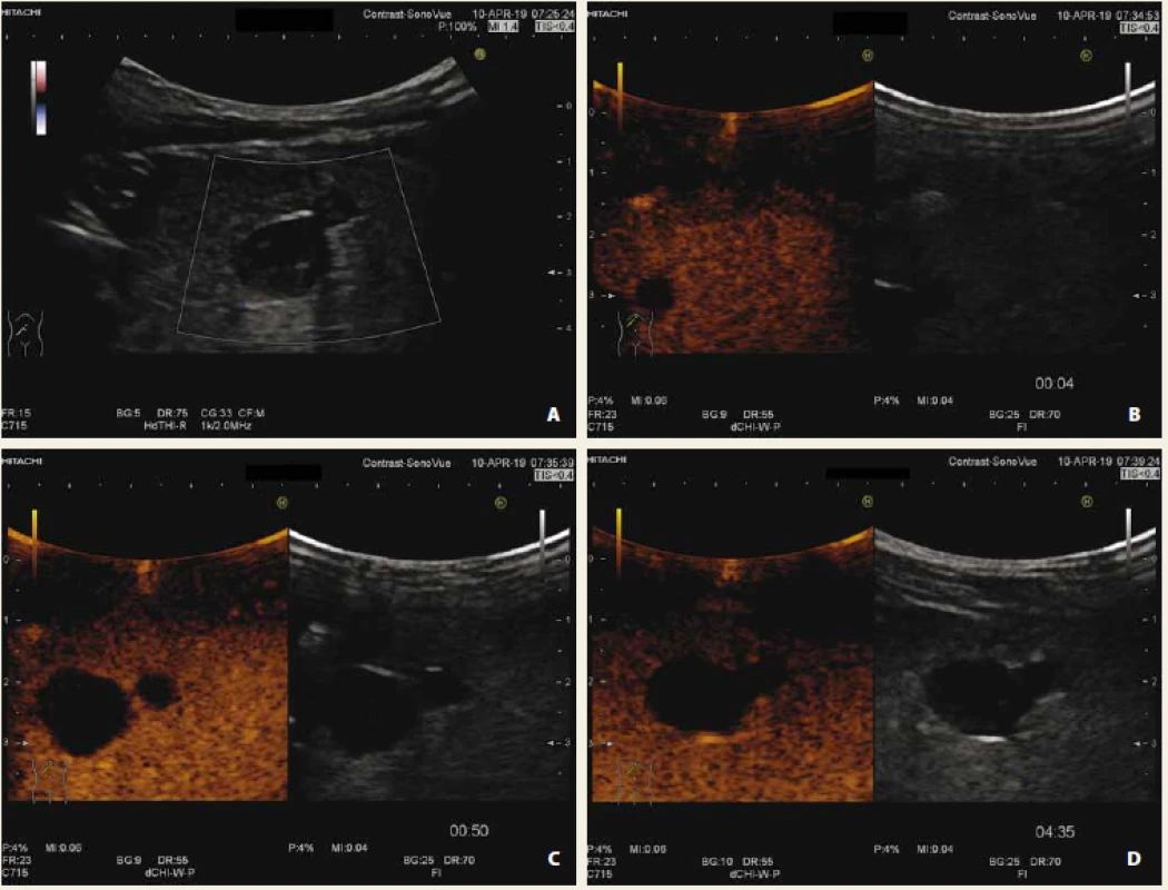 Multilokulární cysta jater nativně; B-mód (A), CEUS arteriální fáze (B), portální fáze (C), pozdní fáze (D). Nedošlo
k žádné opacifikaci léze.<br>
Fig. 1. Multilocular liver cyst native US; B-mode (A), CEUS arterial phase (B), portal phase (C), late phase (D). Without opacification of lesion