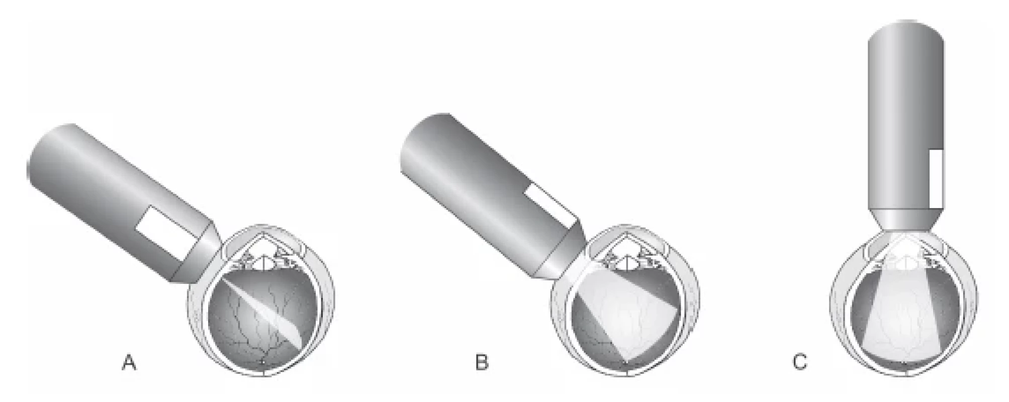 Basic positions of B-probe during transocular UZ imaging: (A) transverse, (B) longitudinal,
(C) axial