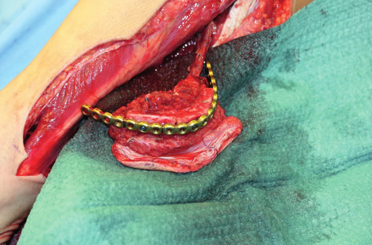 Elevated fibula flap after modelling along the shape of the reconstructive splint, hanging perfused on a lower limb (author’s archive)