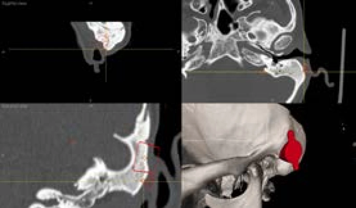 Systém BoneBridge – předoperační 3D model, software
BB FastView (zdroj: archiv KOCHHK FNUSA)