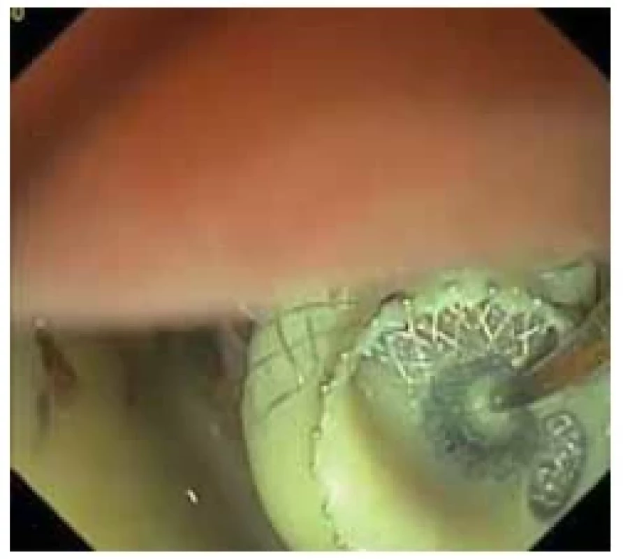 Proximální fl ange s vytékajícím
hnisem po zavedení LAMS. <br> 
Fig. 3. Proximal fl ange with oozing pus after
LAMS insertion.