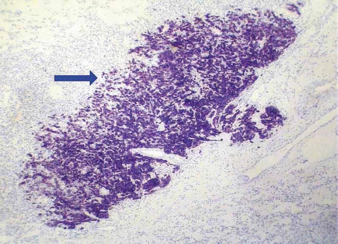 Strong immunoreactivity of metastatic adenocarcinoma for cytokeratin 7
(blue arrow), while surrounding RCC tissue is negative (clone OV-TL 12/30, magnification 100×).
