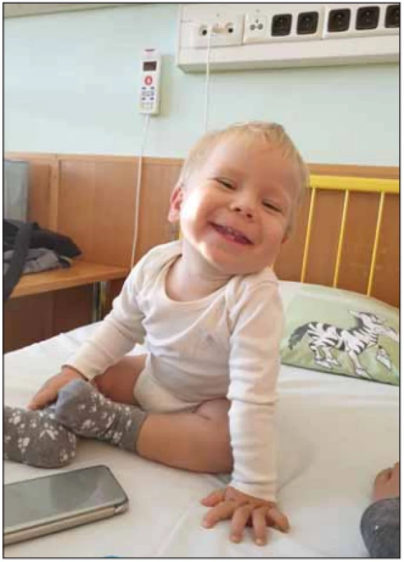  Batole se SMA II.<br>
Fig. 5. A child with SMA II
