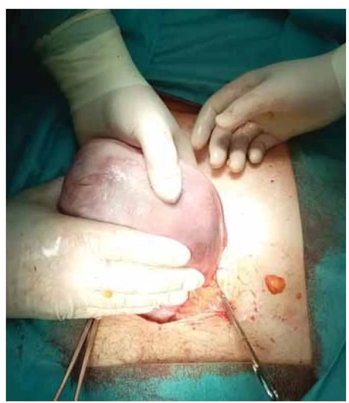 Reponovaná děloha (zdroj: archiv autorů).<br>
Fig. 3. Repositioned uterus (source: authors’ archive).