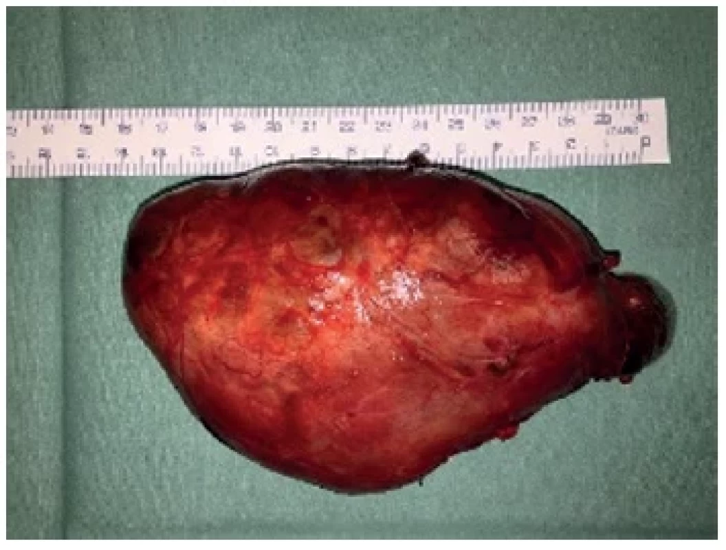 Pravostranná hemityreoidektomie – preparát <br> 
Fig. 3. Right hemithyroidectomy – specimen