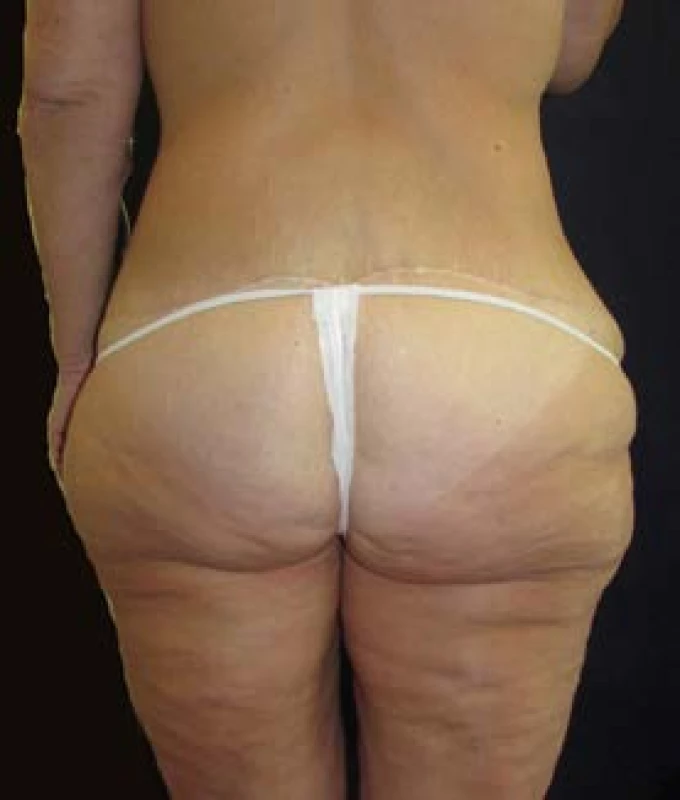 Lower body lifting – pohled zezadu