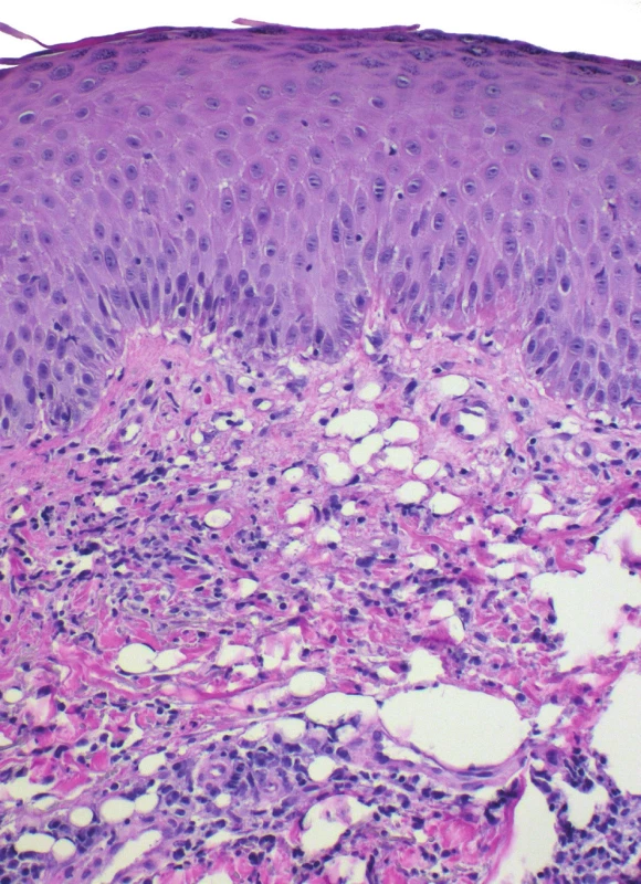 Pseudolipomatosis cutis horního koria
