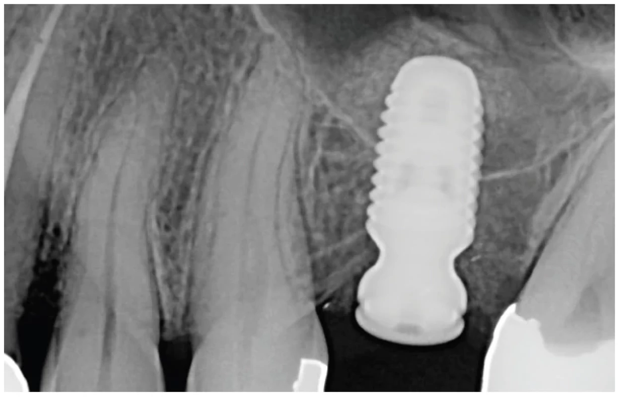 RTG snímek ihned po
implantaci ukazuje přesně
ohraničený radioopakní
alograft a implantát
zasahující do alveolárního
recessu; augmentát má
pravidelný tvar kolem apexu
implantátu, tudíž můžeme
říct, že Schneiderova
membrána je intaktní <br> 
Fig. 2 Radiographic immage
immediately post implantation
showing the sharply
demarcated radioopaque
allograft as well as the
implant in the alveolar recess;
the regular shape of the
augmented material around
the apex of the implant
is a good indication that
the Schneiderian membrane
is intact
