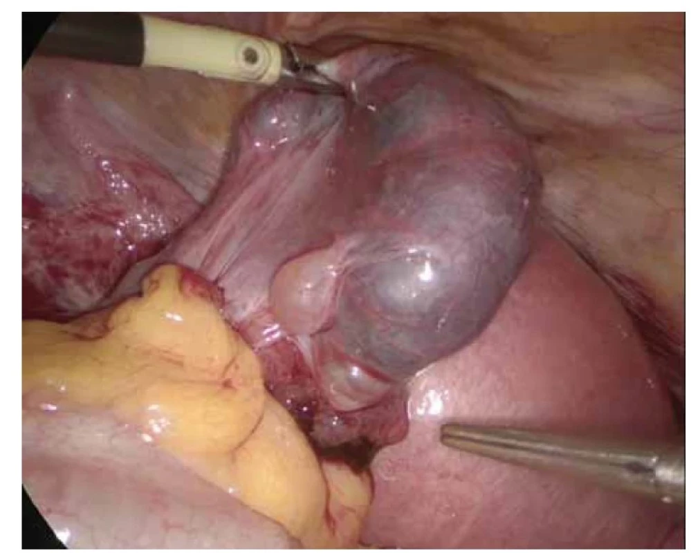 Nález z laparoskopie 5. 5. 2022 – levá tuba téměř celá destruována ektopickou
tubární graviditou.<br>
Fig. 1. Findings from laparoscopy May 5th, 2022 – the left salpinx almost completely
destroyed by ectopic tubal pregnancy.