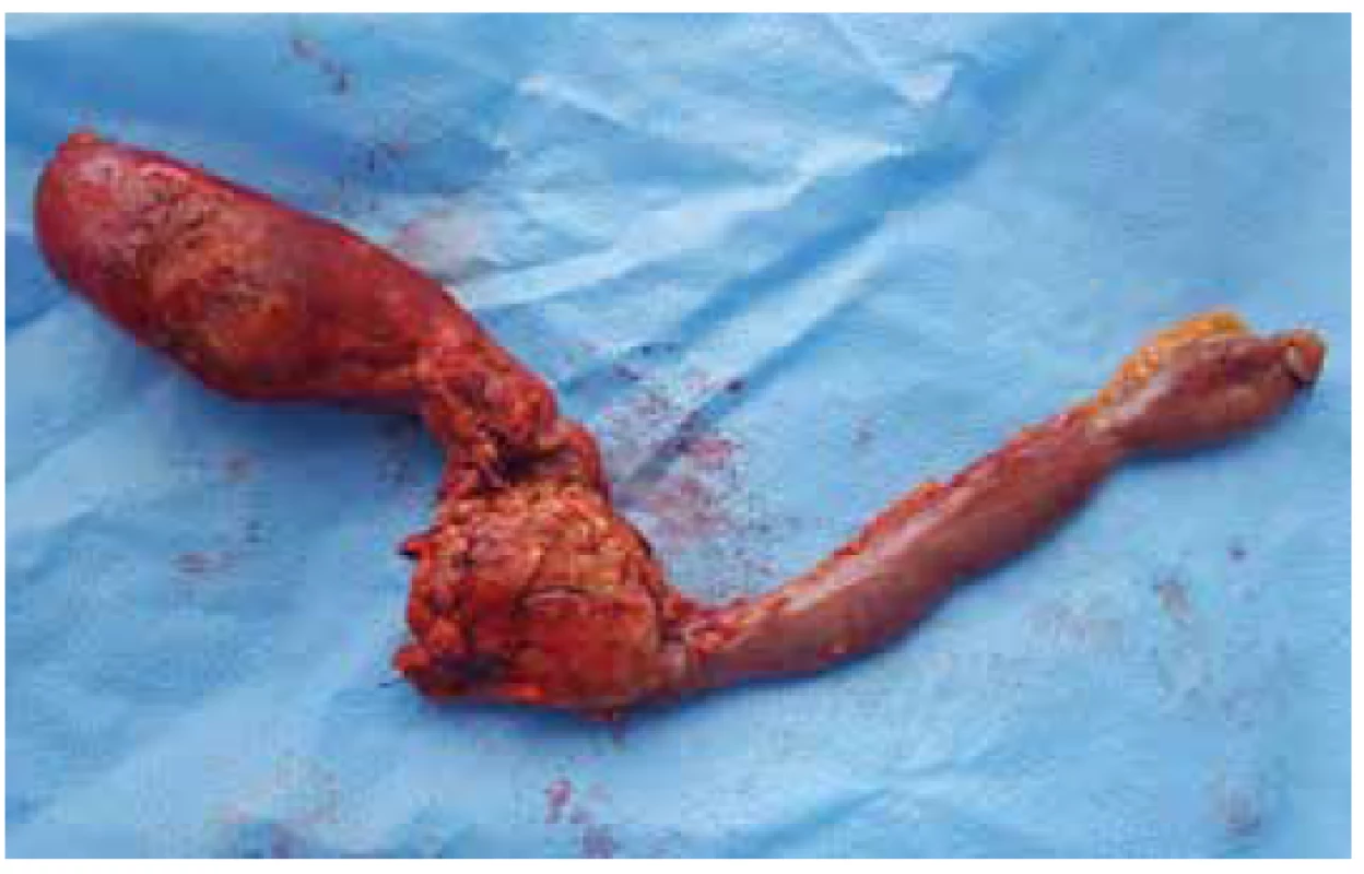 Preparát: žlučník, hlava pankreatu, duodenum in toto<br>
Fig. 5. Specimen: gallbladder, head of pancreas and duodenum
in toto