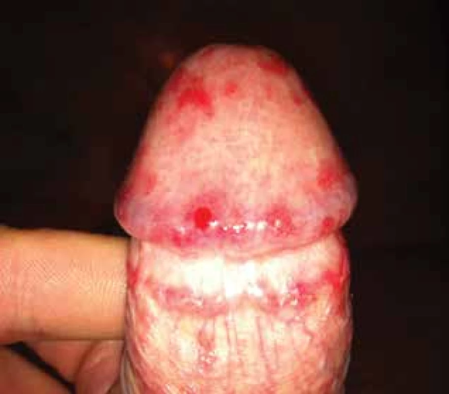 Herpes genitalis