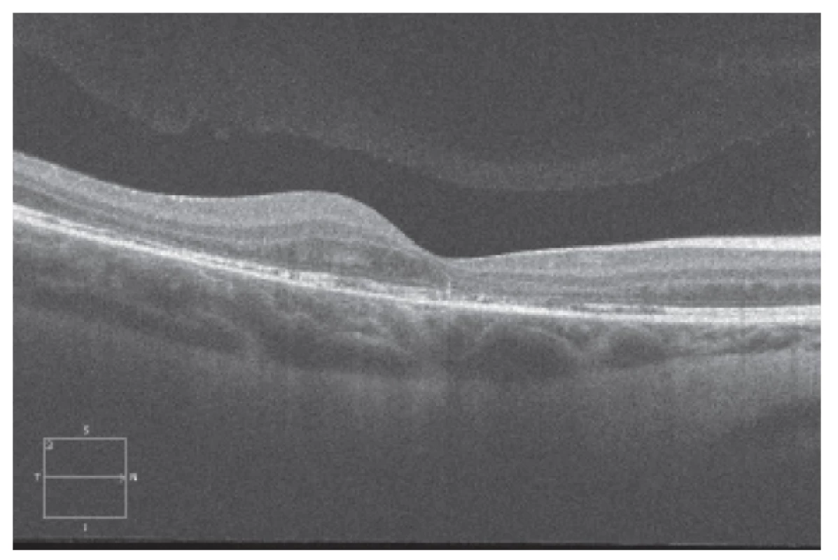Spectral HD OCT Linear horizontal macular scan after 3 intravitreal
injections of ranibizumab (Lucentis) at long-term follow-up
(˃ 12 months) with stable macular finding, without progression