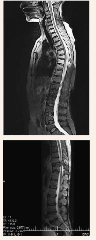 Vyšetrenie zobrazovacími metódami:
MRI osteoporotické kompresívne fraktúry.
Archív Onkologického ústavu sv. Alžbety, s.r.o.,
Bratislava