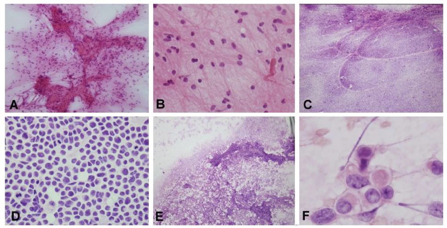 (A, B) Nádor mozočka u 6-ročného chlapca, s typickou radiologickou prezentáciou – cysta s kontrast-pozitívnym murálnym uzlíkom. V náterovej cytológii
bolo zrejmé, že sa jedná gliový tumor s cytologicky blandnými bunkami usporiadanými okolo abnormálnej cievy (pripomína mikrovaskulárnu proliferáciu
high-grade gliómov, ale stena je pravdepodobne hyalínne zmenená) (A). V detaile monotónna populácia s blandnými jadrami a dlhými piloidnými výbežkami.
Užitočným pomocným znakom je prítomnosť Rosenthalovych vláken. Peroperačná a definitívna diagnóza: pilocytický astrocytóm. (C, D) Solídny, kontrast-pozitívny
tumor mozočka u 5-ročného chlapca. Náter bol rovnomerný, išlo o léziu s nízkou kohezivitou nádorových buniek (C). Jednalo o malé bunky s minimom
cytoplazmy, „salt and pepper“ chromatínom, bez nápadnejších jadierok a početnými mitózami a apoptózami (D). Peroperačná a definitívna diagnóza: medulloblastóm,
klasický typ. U dospelého pacienta by pri podobnom náleze bola v diferenciálnej diagnóze na prvom mieste metastáza malobunkového karcinómu.
(E, F) Tumor IV. komory u 2–ročného chlapca. V náterovej cytológii boli zachytené jednak kohezívnejšie pseudopapilárne usporiadanie, celkovo však
bol náter diskohezívny (E). Vo veľkom zväčšení charakteristické rabdoidné bunky (F). Peroperačná a definitívna diagnóza: atypický teratoidný/rabdoidný tumor