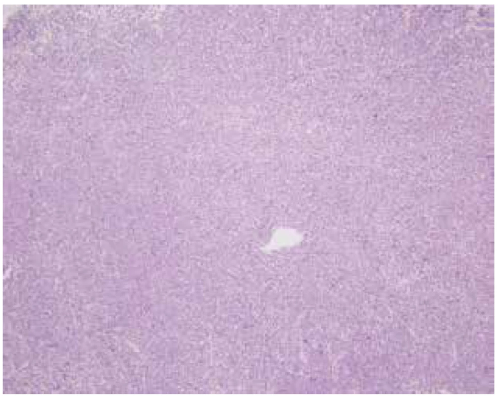 B-lymfom – základní barvení hematoxylin eozin,
100x zvětšeno<br>
Fig. 5. B-lymphoma – hematoxylin and eosin stain, enlarged
100 times