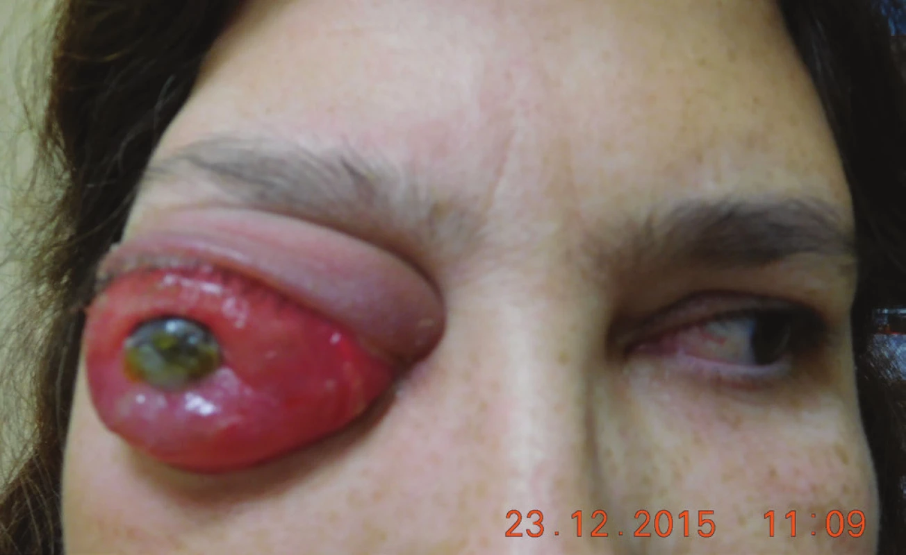 Clinical finding in 12/2015, eye globe prolabse through the
eyelid, progression of corneal lesion