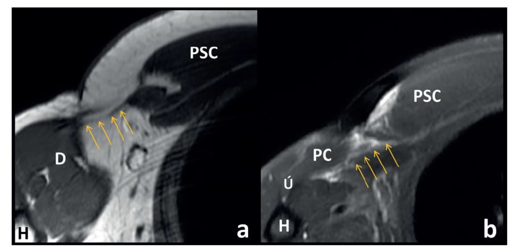 Ruptura šlachy m. pectoralis major na MR axiálních řezech<br>
Fig. 4: MRI axial sections of the pectoralis major rupture