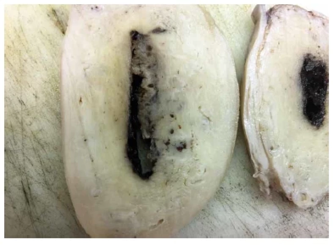 Subinvoluce cév lůžka placenty (placental site subinvolution). Makroskopicky
patrné dilatované cévy v místě lůžka placenty.