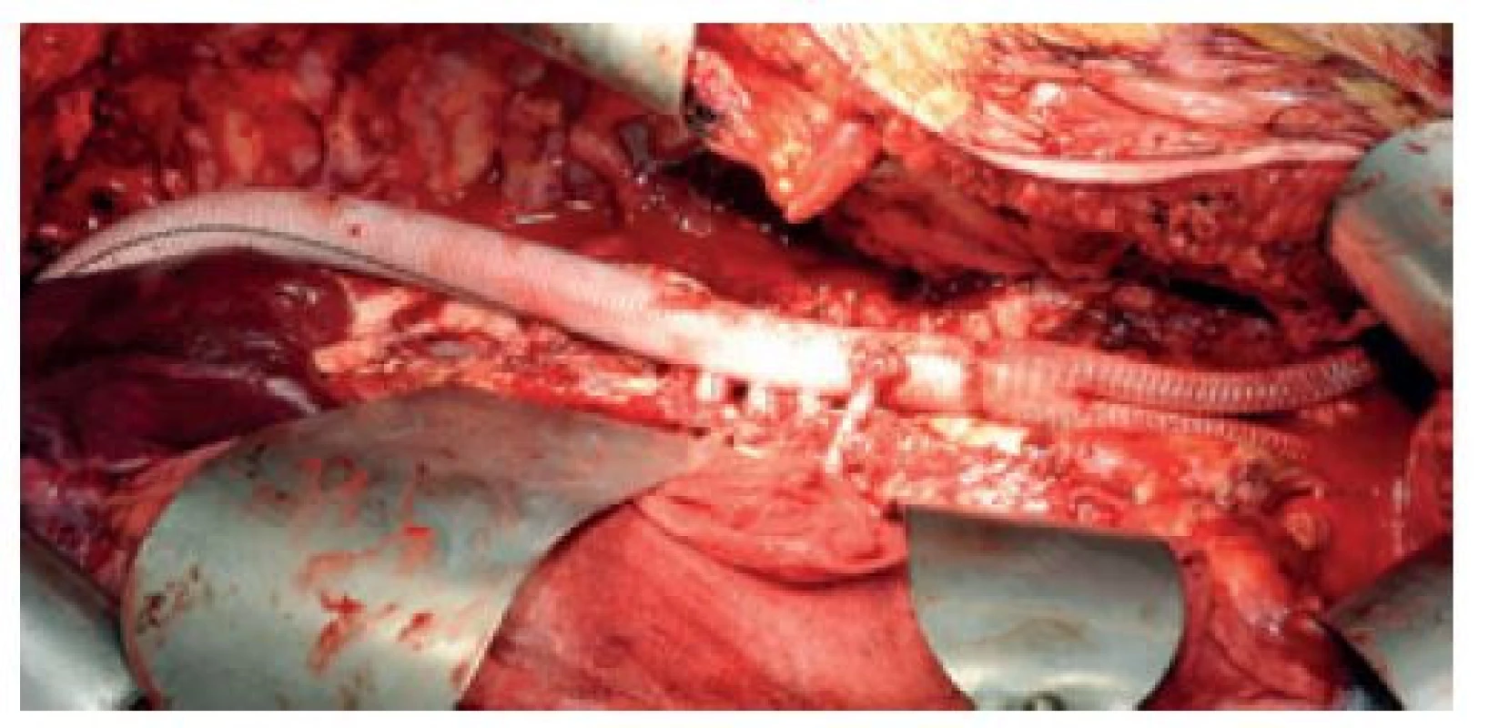 Rozšířená TAAA II náhrada (operační snímek)<br>
Fig. 10: Reconstruction of an extensive type II TAAA (perioperative
photo)